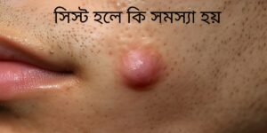 সিস্ট হলে কি সমস্যা হয়