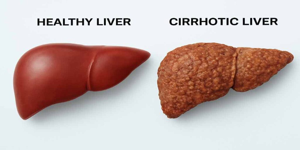 Home স্বাস্থ্য বাংলা লিভার সিরোসিস কি ভাল হয়? চিকিৎসা, লক্ষণ ও সুস্থ হওয়ার উপায়