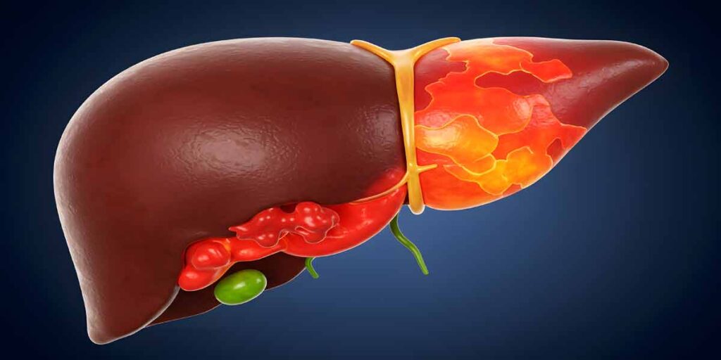 Home স্বাস্থ্য বাংলা লিভার সিরোসিসের লক্ষণ কি কি?